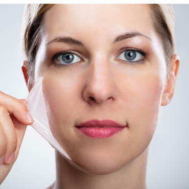 Chemical Peel Treatment